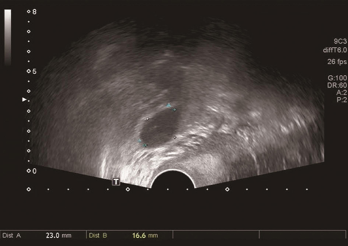 图1 超声下的卵巢肿物.jpg
